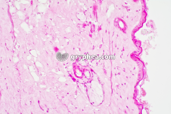 Rejet de greffe de peau x100 - gryphea.com